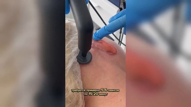 "Именно этот аппарат, который называется INDIBA, помогает восстановиться в кратчайшие сроки"