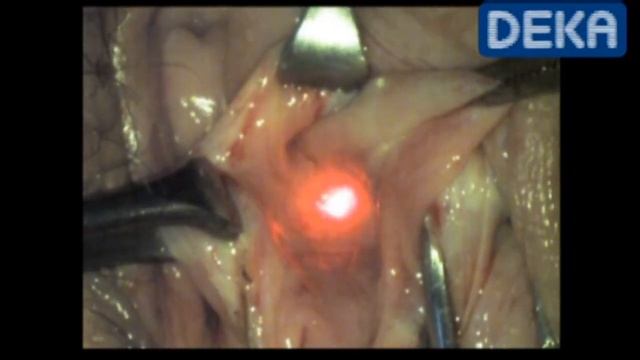 Cyst of Bartholin's Gland CLOVER смотреть онлайн