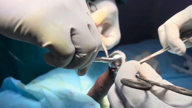 Warning: Live Surgery. Thick Smegma Removal, Frenulectomy, Stapler Circumcision. Dr C Sharath Kumar