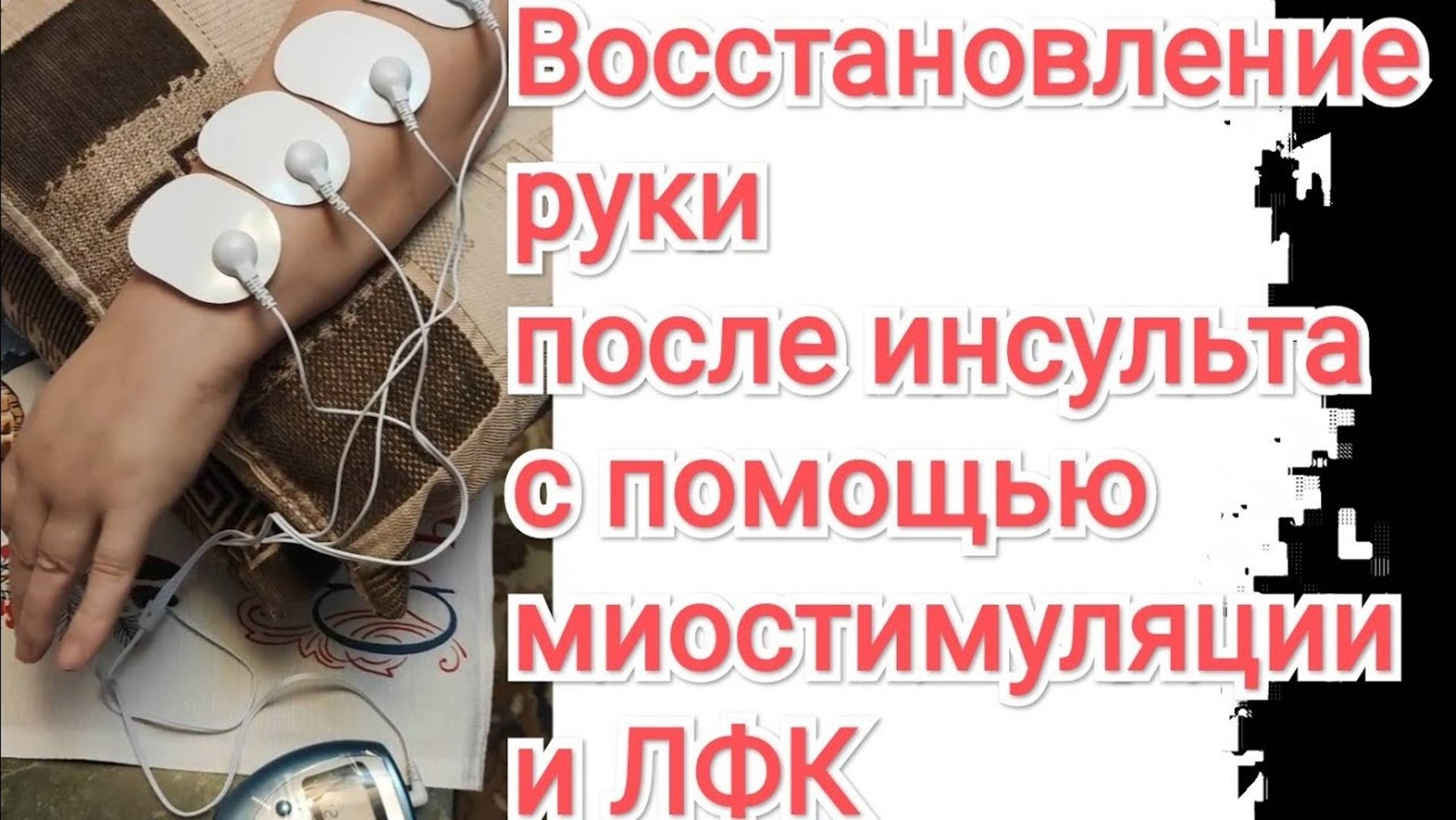 Восстановление руки после инсульта - Миостимулятор и гимнастика смотреть онлайн