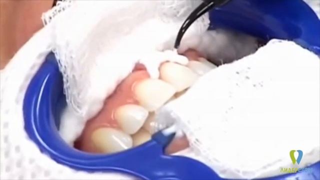 Отбеливание зубов ZOOM в Москве (клиника ЛидерСтом)