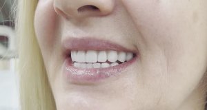 Постоянный керамокомпозитный протез устанавливается сразу и включен в стоимость операции All-On-4