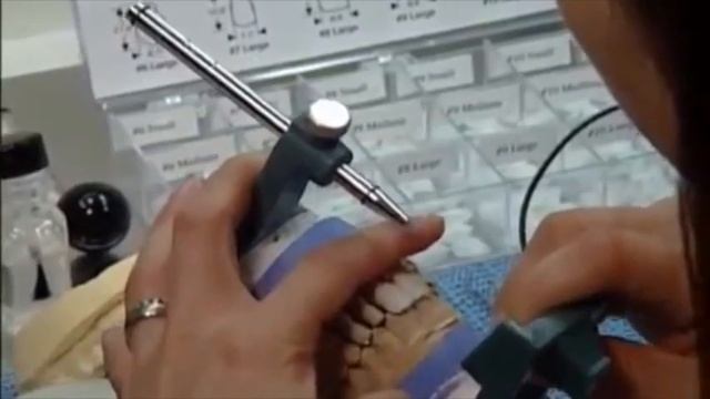 Этапы изготовления реставрации зубов винирами