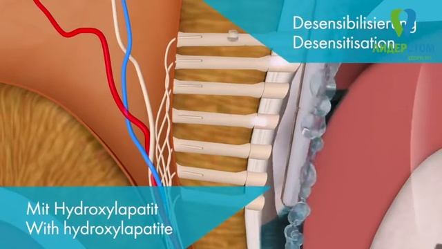 Процедура щадящего лечения десен ультразвуковым аппаратом Vector ParaPro
