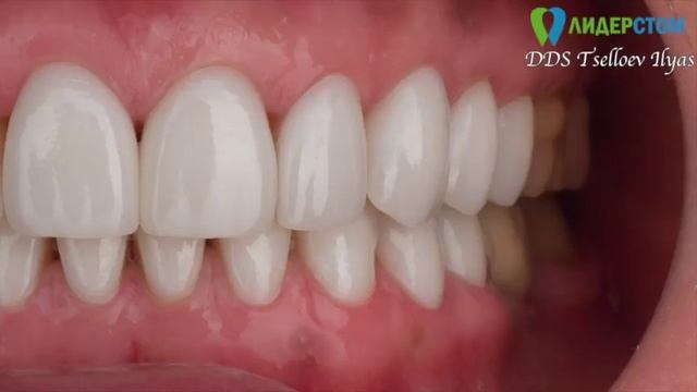 Процесс установки виниров, фото До и После.