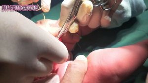 Circumcision By Plastibell Technique