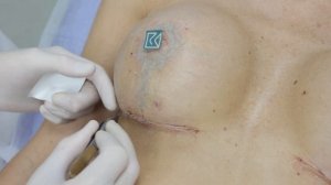 Уход за рубцами. Часть 4