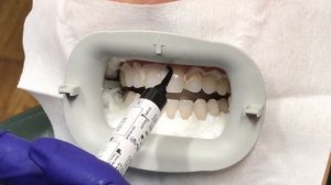 Профессиональное отбеливание зубов ZOOM 4