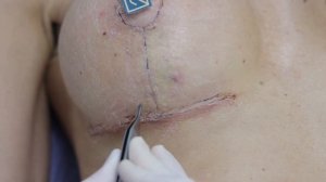 Уход за рубцами. Часть 2