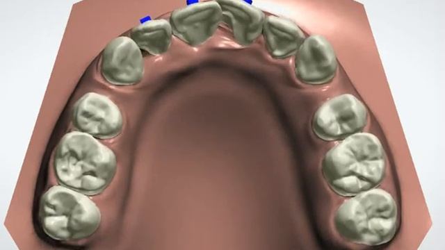 Clear Aligner Animation for treatment plan--Upper Occlusal View смотреть онлайн