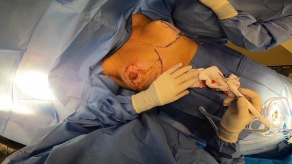 Plastic Surgeon Removes Excess Skin for Breast Lift (Graphic Mastopexy Surgery)