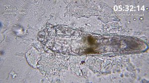 Угревая Железница Demodex | Как СУПЕРЧИСТОТЕЛ убивает клеща