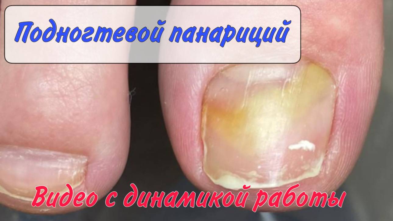 Гной под ногтем/ воспаление под ногтем/ болит под ногтем смотреть онлайн