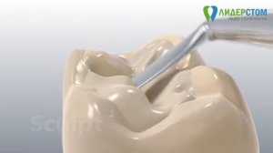 Световая пломба быстро надежно долговечно