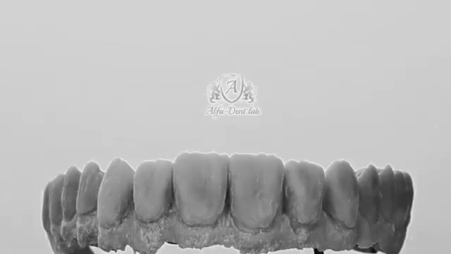 Виниры керамические