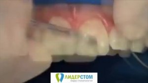 Восстановление передних зубов (видео реставрации переднего резца)
