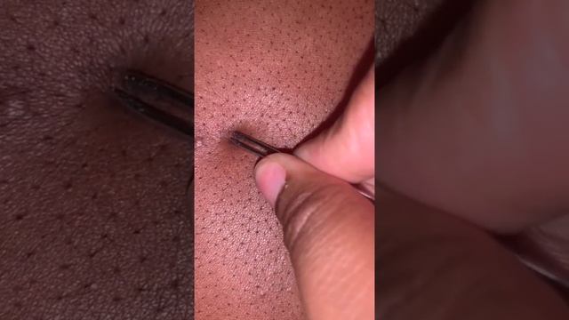 Blackheads 2021 Newest Dr Pimple Popping Videos Ep 220