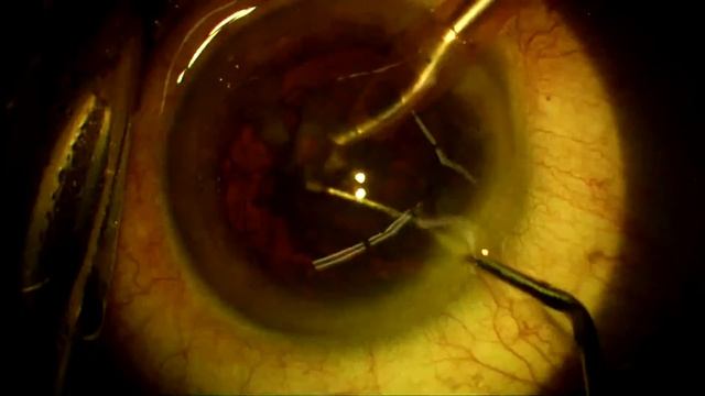 Phaco one-chop nucleotomy + visco-separation + Zeiss monofocal смотреть онлайн