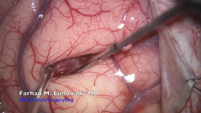 Brain Tumor Surgery In A Lady Who Was Paralyzed Because Of The Tumor.