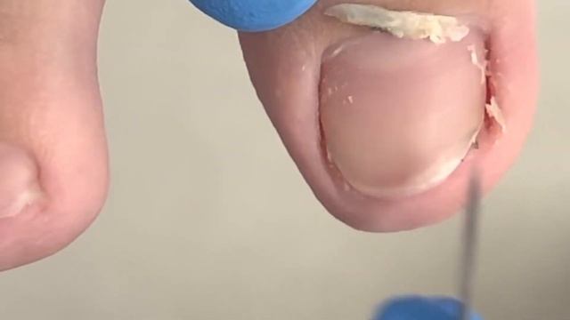 There Were 2 Dirt Spots On The Toenails! Clean Up Thoroughly【Xue Yidao Pedicure】