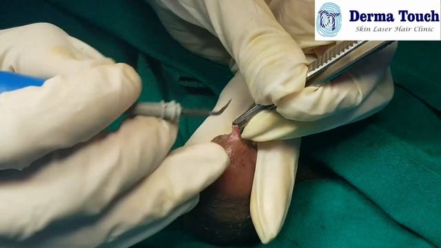 Sebaceous cyst on Penis पेनिस/लिंग पर गांठ смотреть онлайн