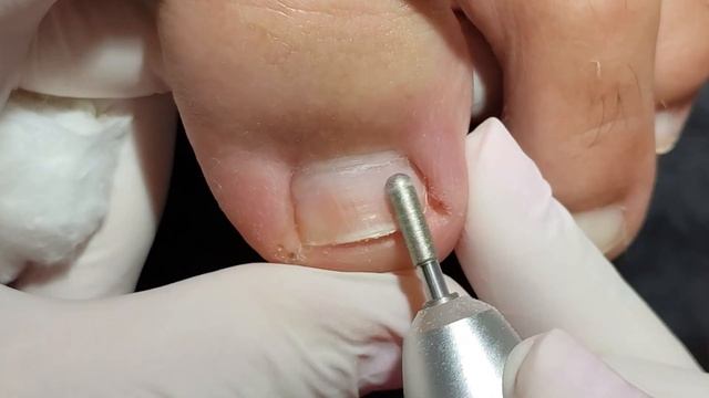 OVERGROWN INFECTED INGROWN TOENAIL REMOVAL смотреть онлайн
