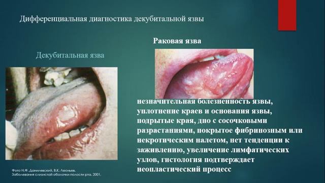 Травматические поражения слизистой оболочки полости рта смотреть онлайн