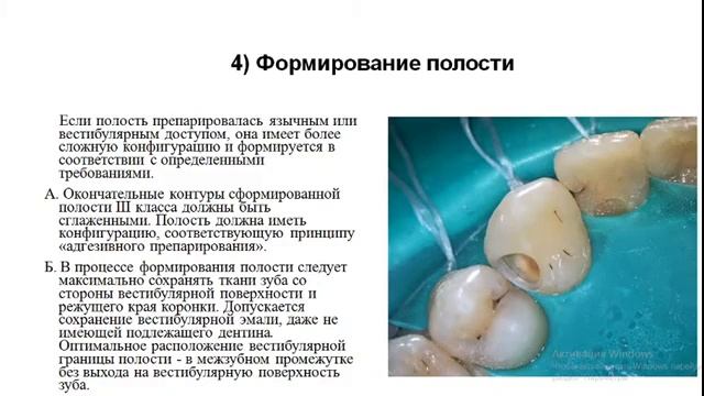 Общие принципы препарирования кариозных полостей смотреть онлайн