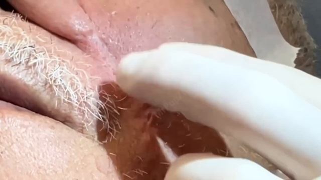 Giant blackheads imbedded in scar tissue extracted. Common occurrence with surgical procedures. смотреть онлайн