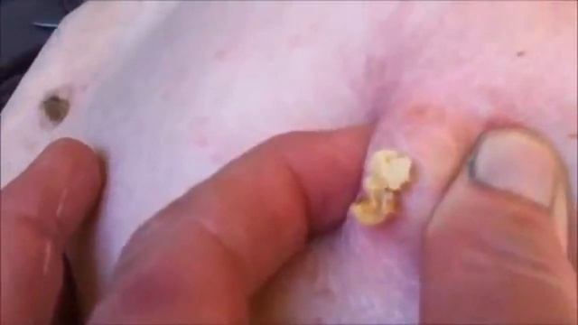 Pimple Popping! 🤢 Disgusting All the Way! 😄 смотреть онлайн