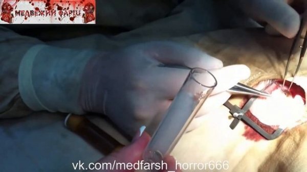 Удаление червя из глаза