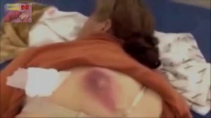 Pimple Popping Fix with Huge Cyst