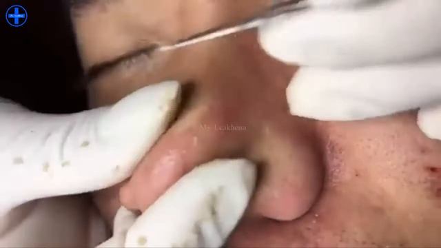 Long And Satisfying Blackhead Extractions: A Dr Pimple Popper Compilation