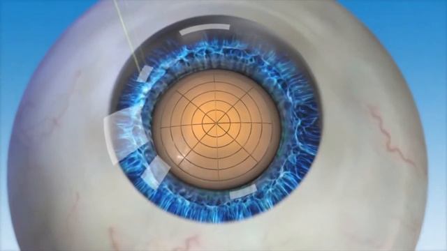 Бионические линзы/BIONIC LENS
