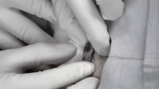 Dr. Lee Is Excited To Remove A 55-Year-Old Blackhead! | Dr. Pimple Popper: 12 Pops Of Christmas