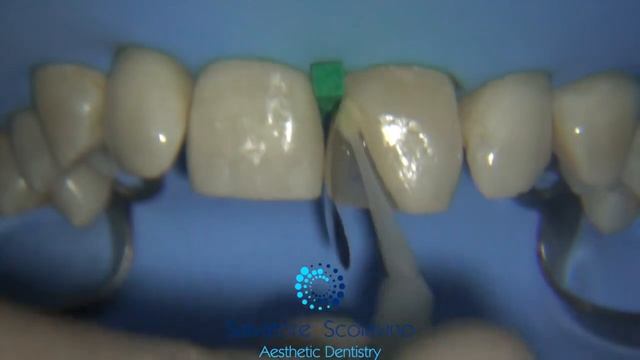 Direct Anterior Restorations смотреть онлайн