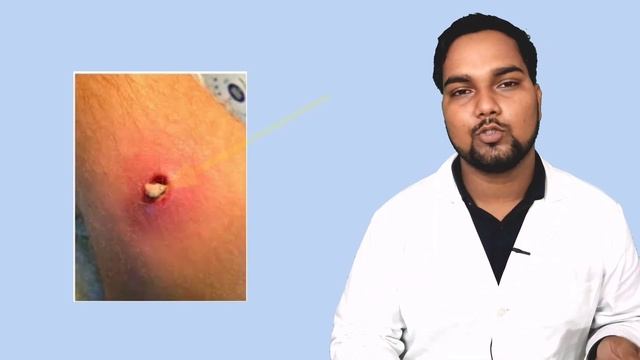 फोड़े फुंसी कैसे ठीक करें | Fode Funsi Kaise Thik Kare Medicine | Boils Treatment at home смотреть онлайн