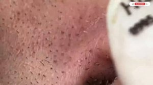 Blackheads Removal from the Nose with Hari's - Satisfying