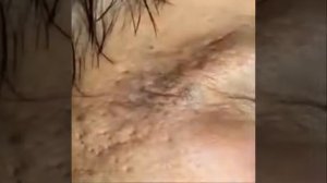 удаление угрей, удаление угрей, угрей End