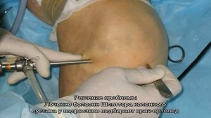 Болезнь Шляттера коленных суставов у подростков