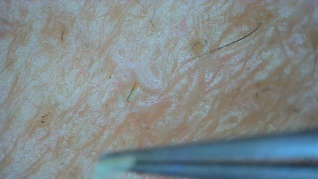 0250 keratin plug removal chin смотреть онлайн