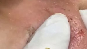 Remoção de cravo 2021 - Pimple Popping 2021 -Blackhead Removal  EP0018