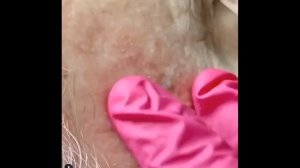 Blackhead removal! Blackhead Extraction/ Big Cystic Acne/ ВЫДАВЛИВАНИЕ ЧЕРНЫХ ТОЧЕК! ПРЫЩИ/ Акне