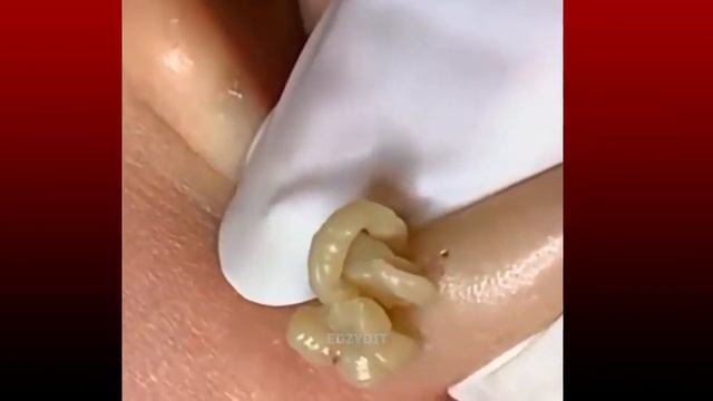 Выдавливание Прыщей выдавливание черных точек под расслабляющую музыку смотреть онлайн