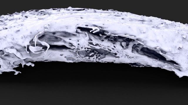 High-Powered Microscopes Capture Cancer Cells In Action