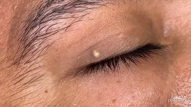 Cyst Vs Lipoma (Short Pops Compilation) | CONTOUR DERMATOLOGY