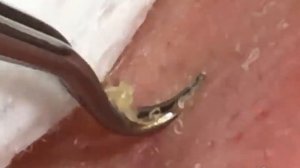 Выдавливание чёрных точек