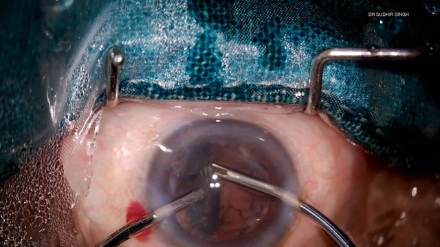 Leica F20 Microscope : Phacoemulsification With Foldable IOL (Unedited)HD смотреть онлайн