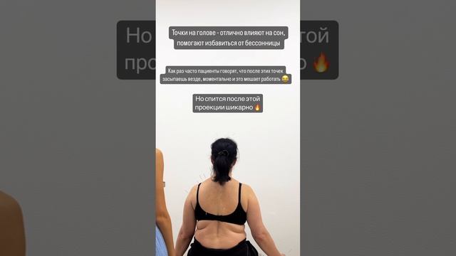 Иглоукалывание головы