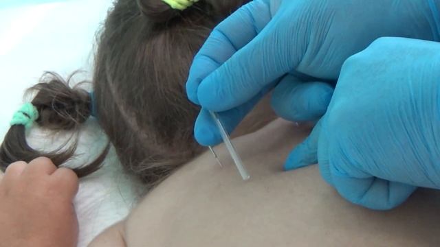 Иглорефлексотерапия смотреть онлайн